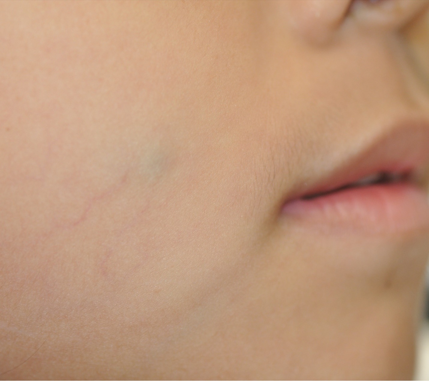 For pilomatricoma, the color of the overlying skin varies from flesh-colored, pink, erythematous, blue, red-blue, to blue-black.