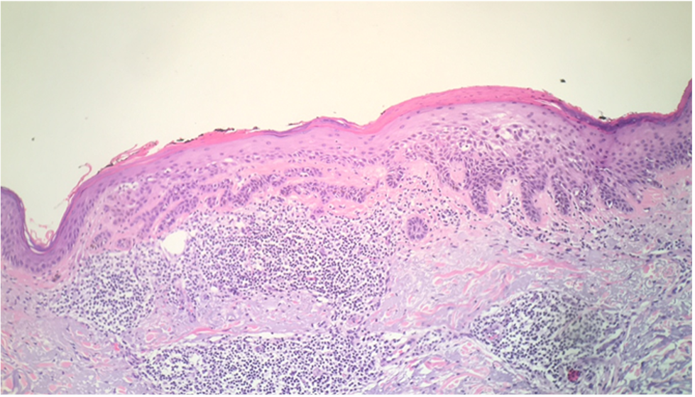 Figure 3. The biopsy would show compact parakeratosis and atypia of the epidermis. Actinic budding would be noted (Hematoxylin and eosin-stained sections; 400× magnification). Image courtesy of Thomas Helm, MD.5