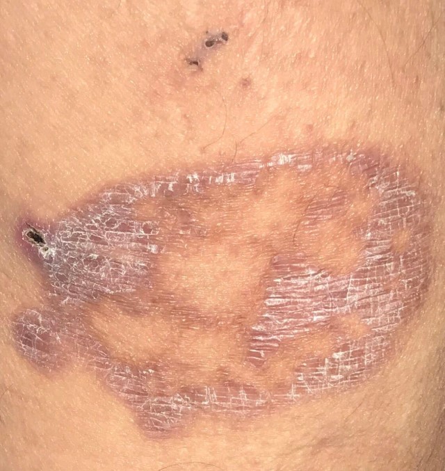 Figure 3. After 5 days of discontinuing doxycycline, the lesion started to heal. Note the double open comedones, which are a classic sign of hidradenitis suppurativa.