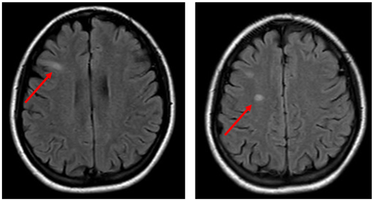 Figure 3. A magnetic resonance imaging scan showed small areas of abnormal signaling in the right frontal lobe.
