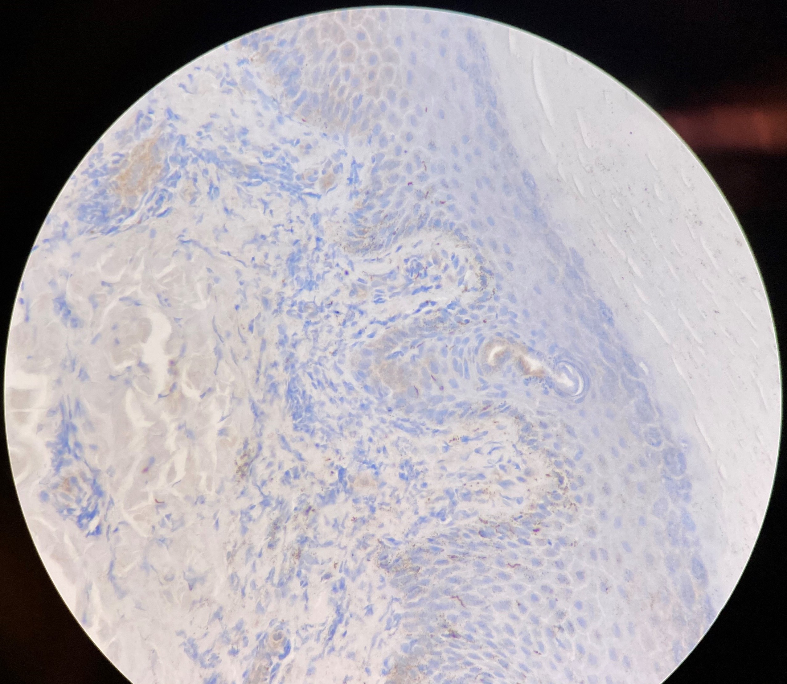 Figure 4. A Treponema pallidum immunostain showed spirochetes, which are elongated, tightly coiled bacteria with tapered ends. Motility occurs via periplasmic flagella or endoflagella.