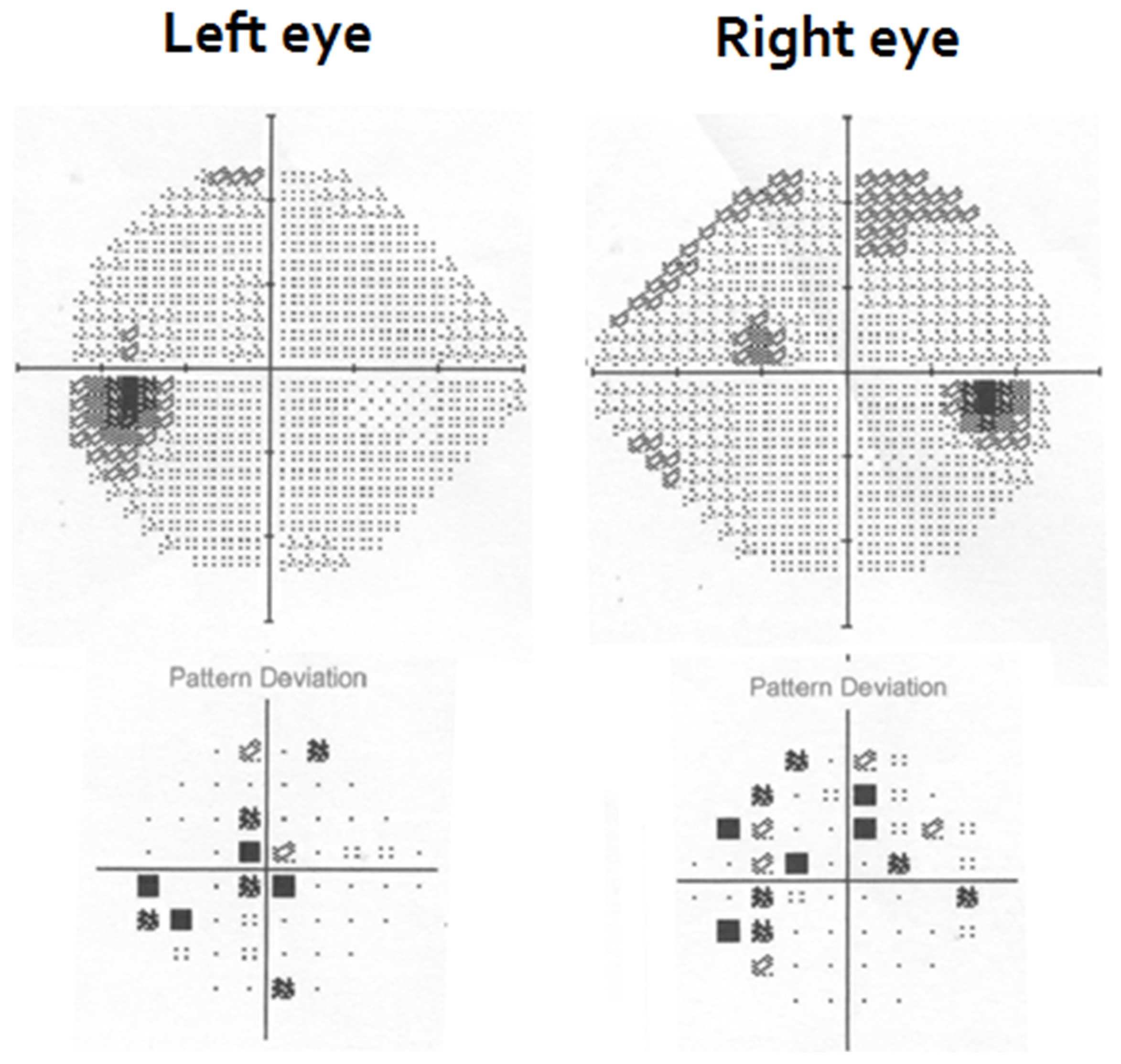 Figure 4. A visual field test demonstrated deficits in the patient’s visual field corresponding to the intraretinal hemorrhages found on fundoscopic imaging.