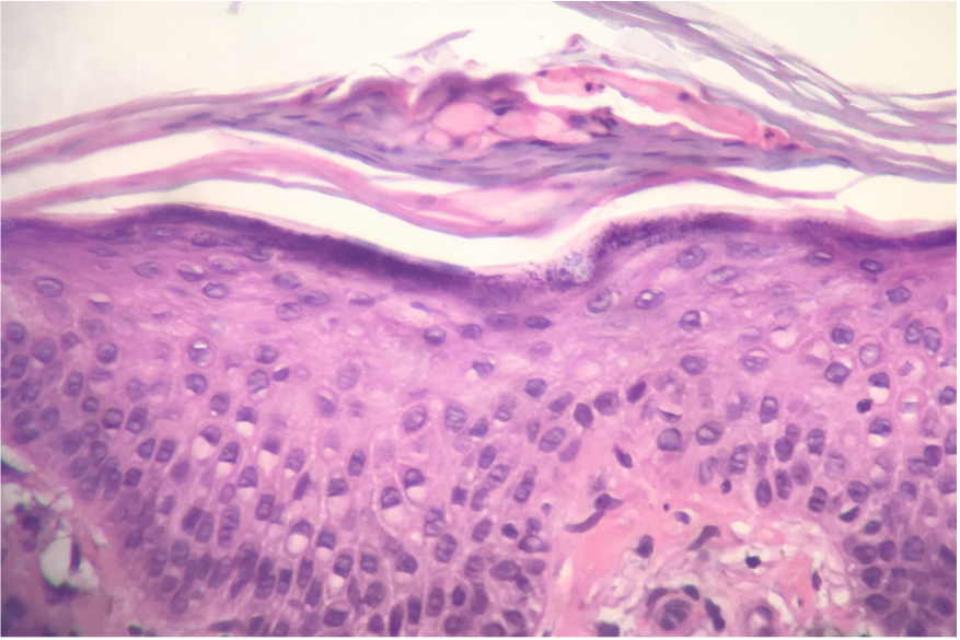 Figure 4. The biopsy would reveal spongiosis and scale crust. Atypia of the epidermis is not identified. (Hematoxylin and eosin-stained sections; 400× magnification) Image courtesy of Thomas Helm, MD.5