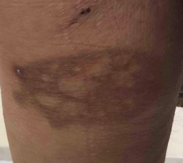 Figure 4. After 2 months of discontinuing doxycycline, the lesion healed with residual post-inflammatory hyperpigmentation.