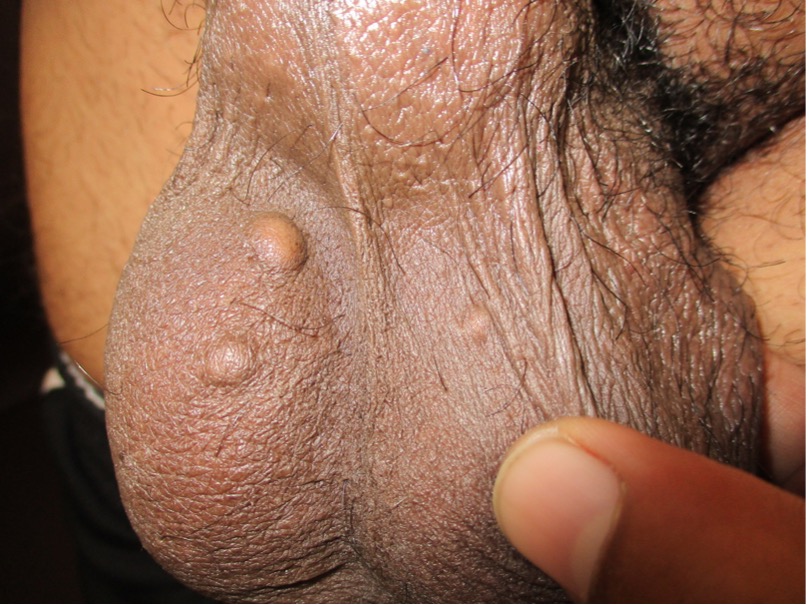 Figure 5. Nodules are initially skin-colored but may become whitish to yellowish or brownish over time.