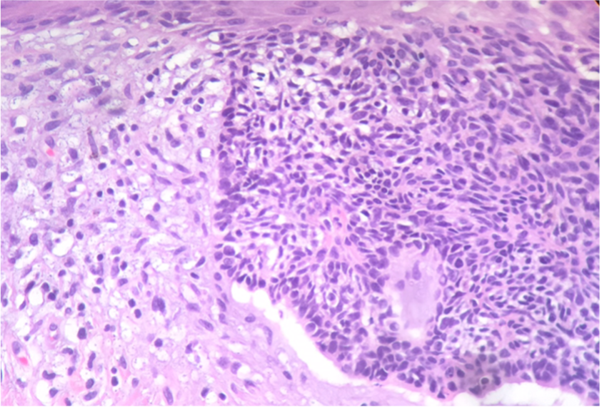 Figure 5. A biopsy would reveal a tumor composed of basaloid cells with scanty cytoplasm. Retraction artifact is noted, and there is peripheral palisading of nuclei (Hematoxylin and eosin-stained sections; 400× magnification). Image courtesy of Thomas Helm, MD.5