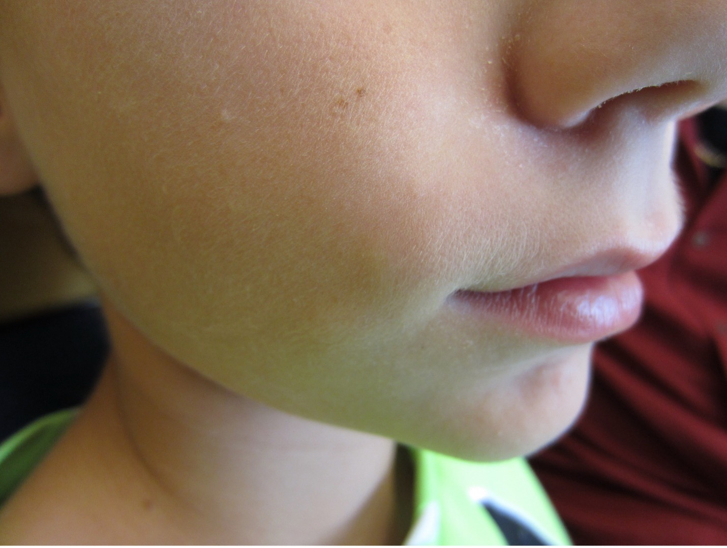 Multiple facets and angles may appear when the overlying skin is stretched (“tent” sign).