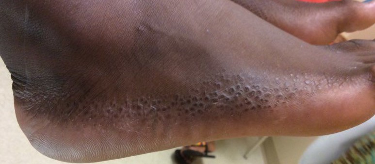 Figure 1. Polygonal, keratotic papules, many of which had slightly depressed centers on the marginal border of bilateral feet.