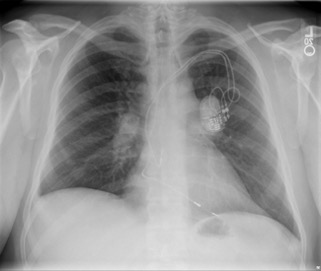 Chest radiograph