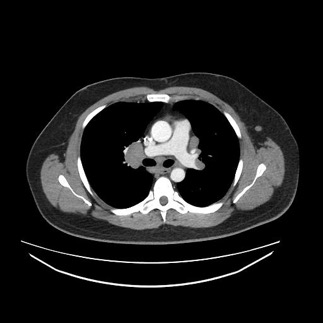 computed tomography of chest