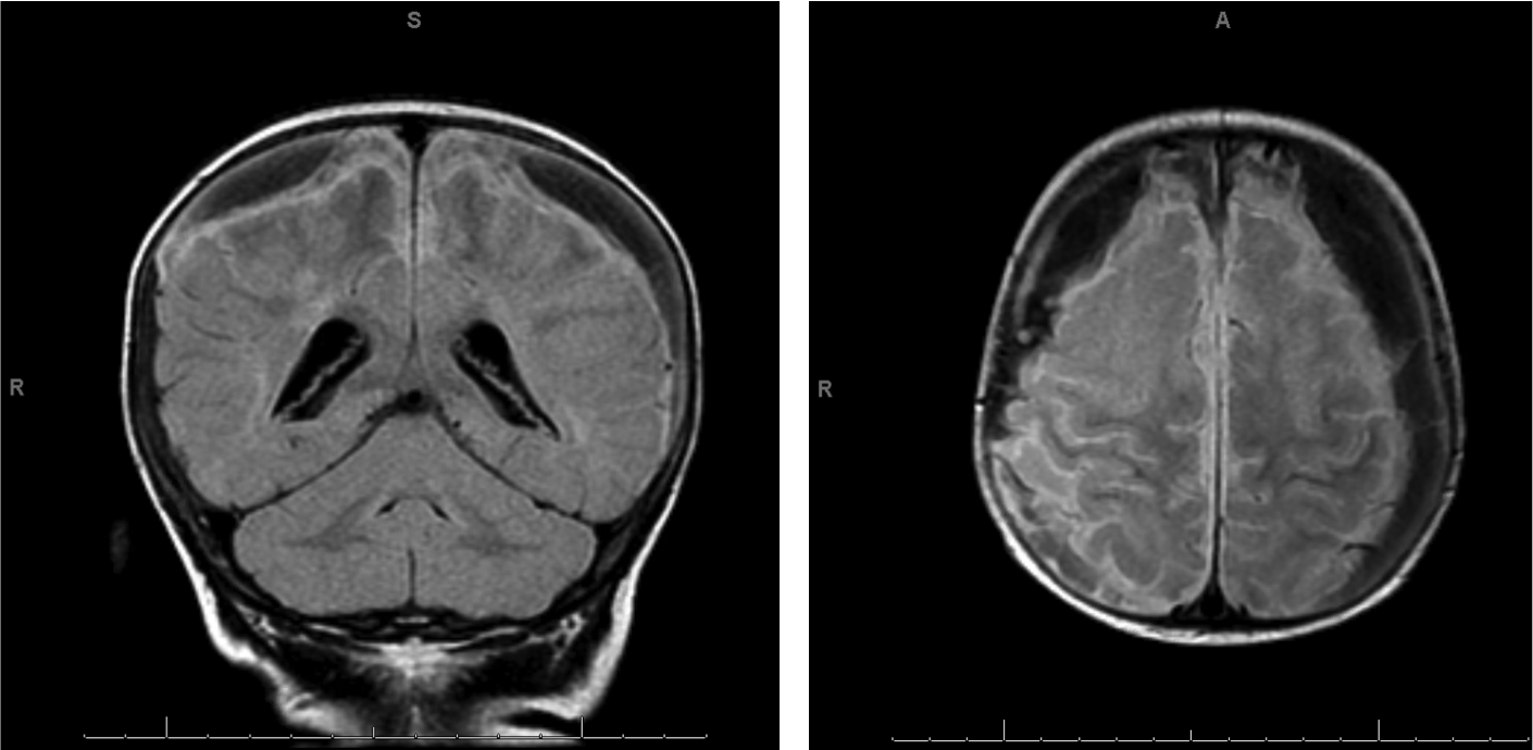 Figure 1. An MRI scan of the brain showed bilateral subdural collections with maximal thickness of 1.3 cm bilaterally. There is a mass effect on the underlying brain parenchyma without midline shift or downward transtentorial herniation or hydrocephalus.