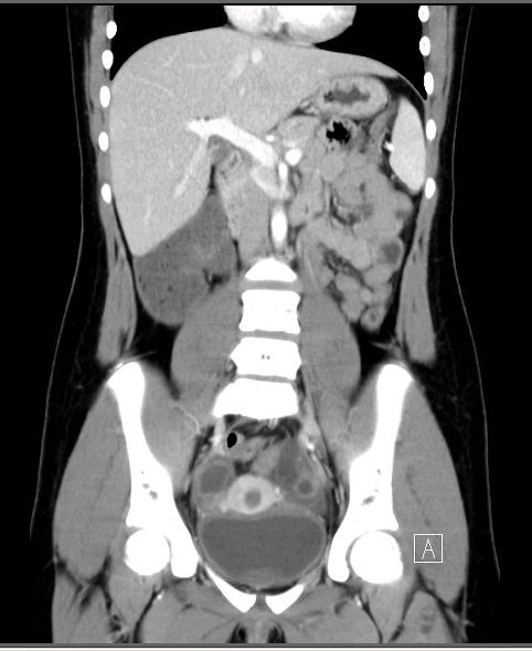 Figure 1. The patient’s uterus and ovaries appeared normal.