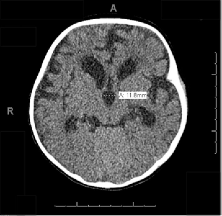 Figure 2. A head CT showed hydrocephalus with the third ventricle measuring up to 11.8 mm maximal transverse dimension. The gray-white matter junction was normal. No acute hemorrhage or intraparenchymal mass effect were noted.