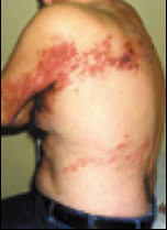Multidermatomal Simultaneous Involvement of Two Dermatomes | Consultant360