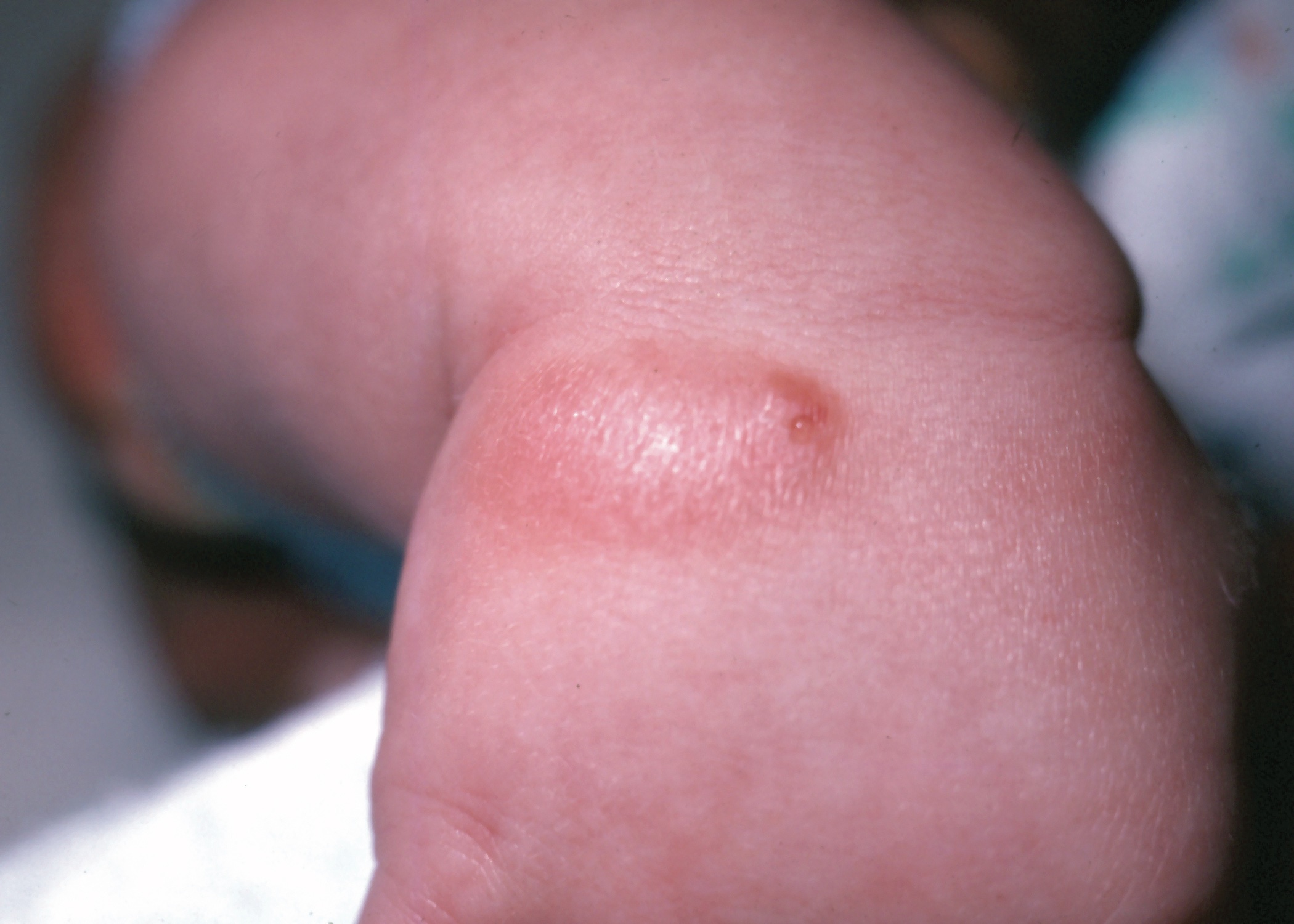 0608CFP_CP_Mastocytoma_2