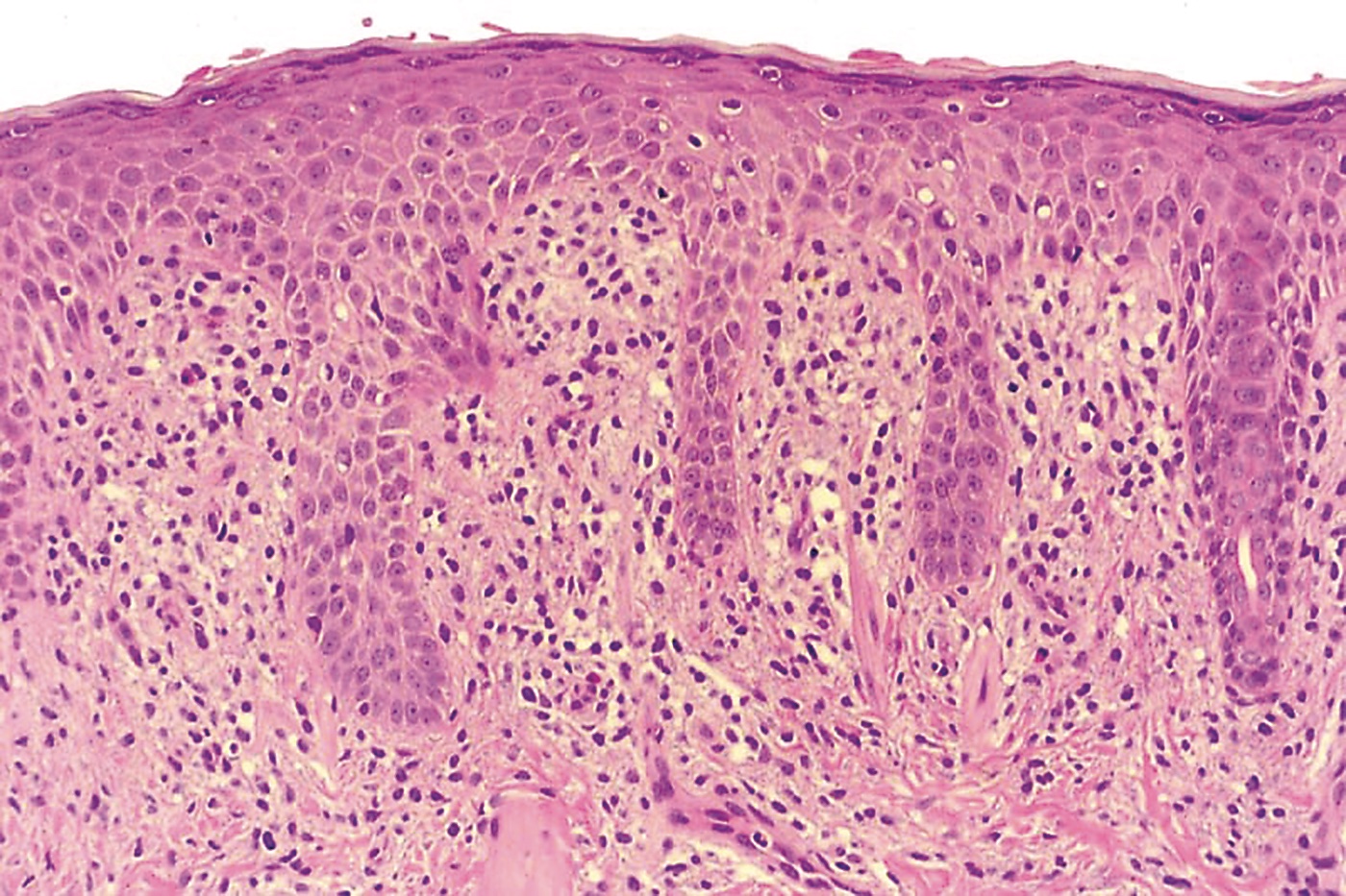 0608CFP_CP_Mastocytoma_3a