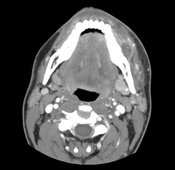 Odontogenic Abscess Complicated by Hyperglycemia