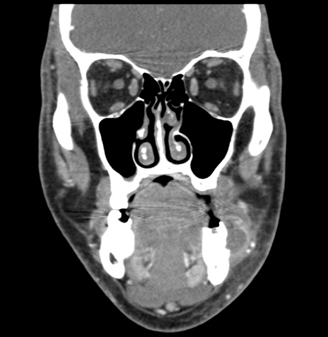 Odontogenic Abscess Complicated by Hyperglycemia