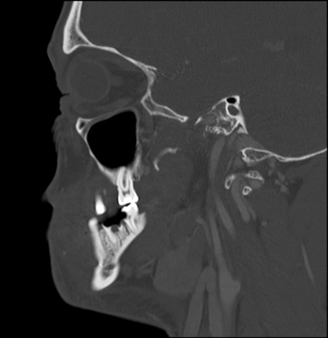 Odontogenic Abscess Complicated by Hyperglycemia