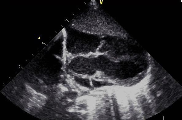 Pulmonary Atresia With Ventricular Septal Defect and Major Aortopulmonary Collateral Arteries