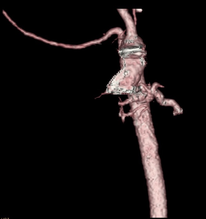 Pulmonary Atresia With Ventricular Septal Defect and Major Aortopulmonary Collateral Arteries
