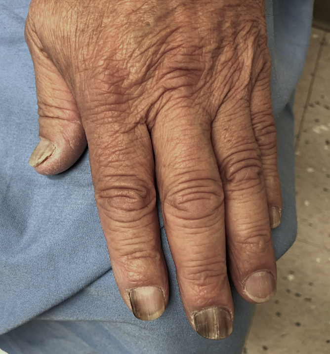 Hydroxyurea-induced melanonychia