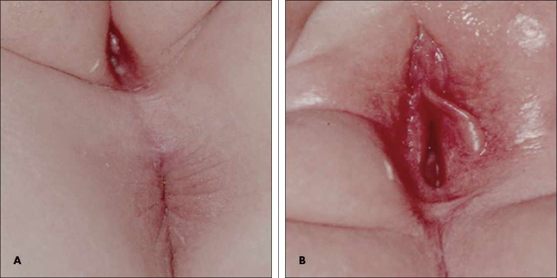 Figure 2 – Female adult pinworms are white, pin-shaped, and 8 to 13 mm long (A and B).