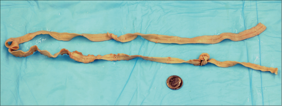 Figure 1 – An adult tapeworm is shown here.