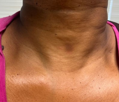 Recurrent Pruritic Erythematous and Pigmented Plaques | Consultant360