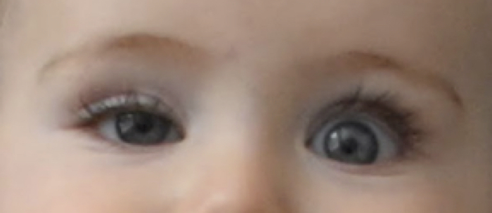 Figure 1. Unilateral ptosis of the patient at rest.