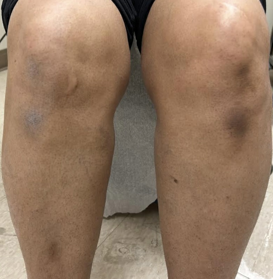 The patient presented with patches that were dark brown, thin, and symmetrically distributed.