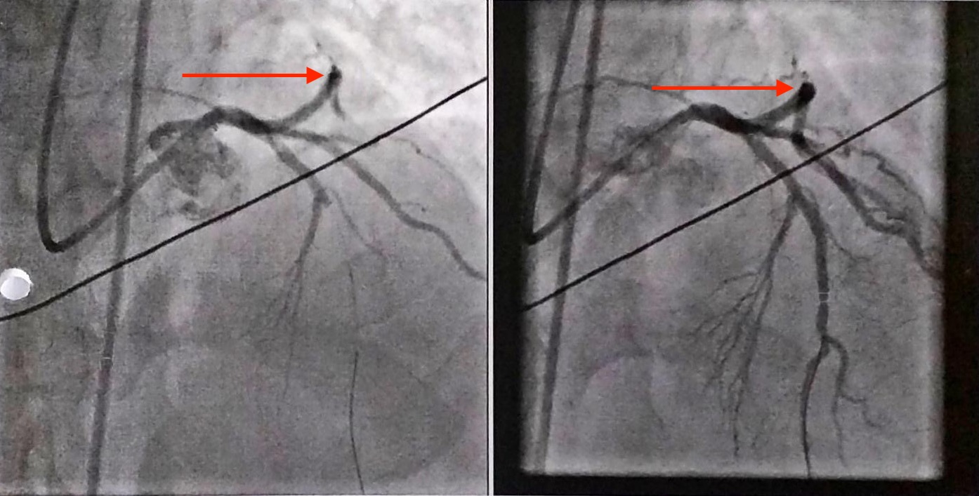 Figure 2. A coronary angiogram was performed shortly after admission. Note the occlusion of the posterior mid-left anterior descending coronary artery.