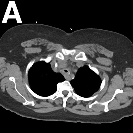 Figure 2. An axial view (A) and sagittal view (B) of the CT angiography of the chest showed focal narrowing of the midthoracic trachea approximately 5 cm below the glottis.
