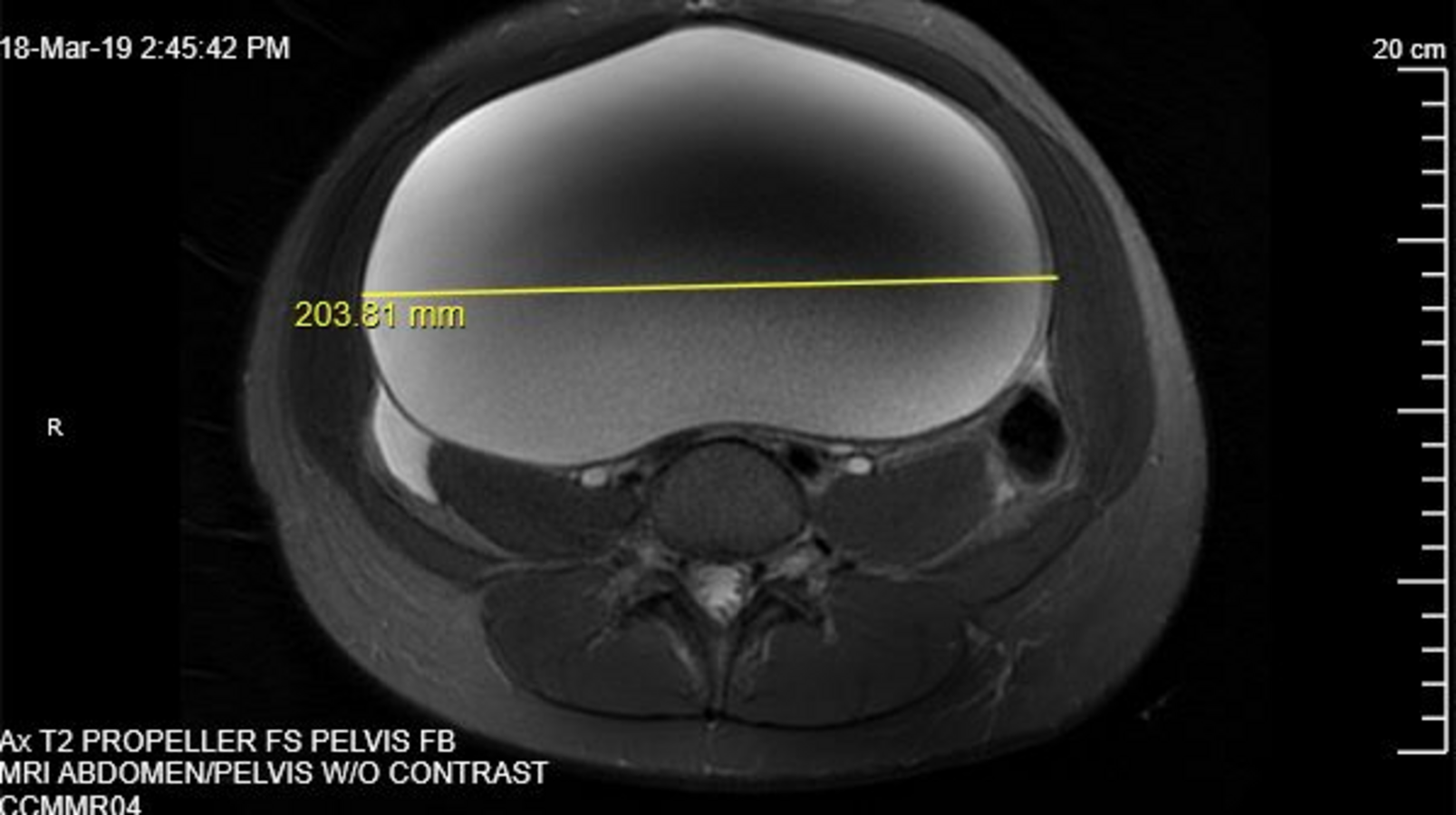 Figure 3. The mass appeared as a unilocular cyst with smooth contours, suggesting a benign etiology.