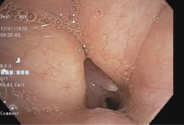 Figure 3. Results of a bronchoscopy confirmed tracheal stenosis approximately 67 days following extubation.