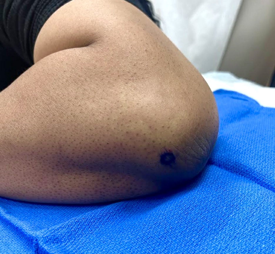 A biopsy was taken of the hyperpigmented plaque on the patient’s right elbow. 