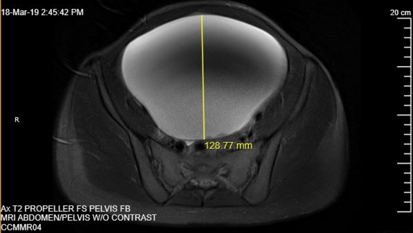 Figure 3. The mass appeared as a unilocular cyst with smooth contours, suggesting a benign etiology.