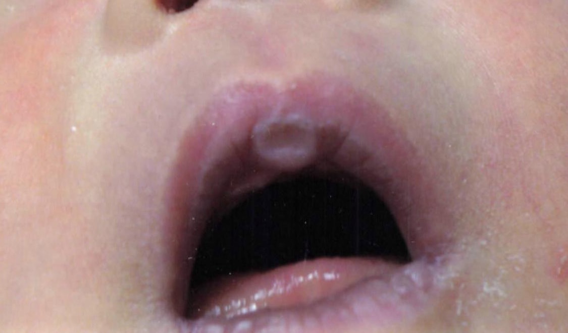 Figure 4. Neonatal Sucking Pads of the Lips