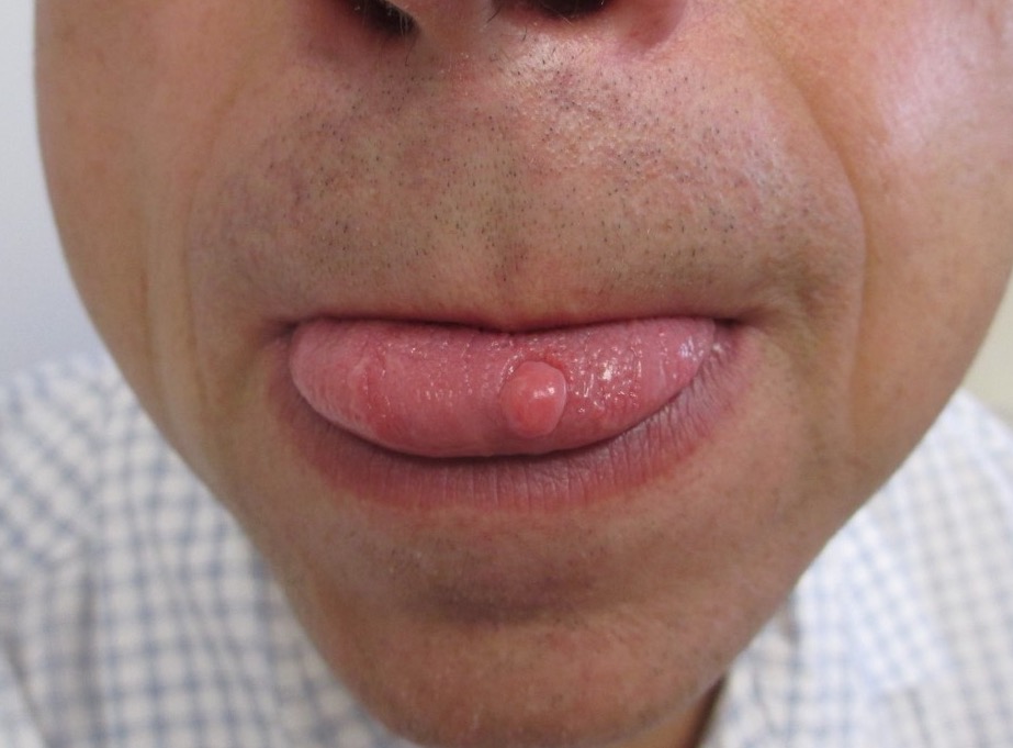 Figure 5. Traumatic Fibroma