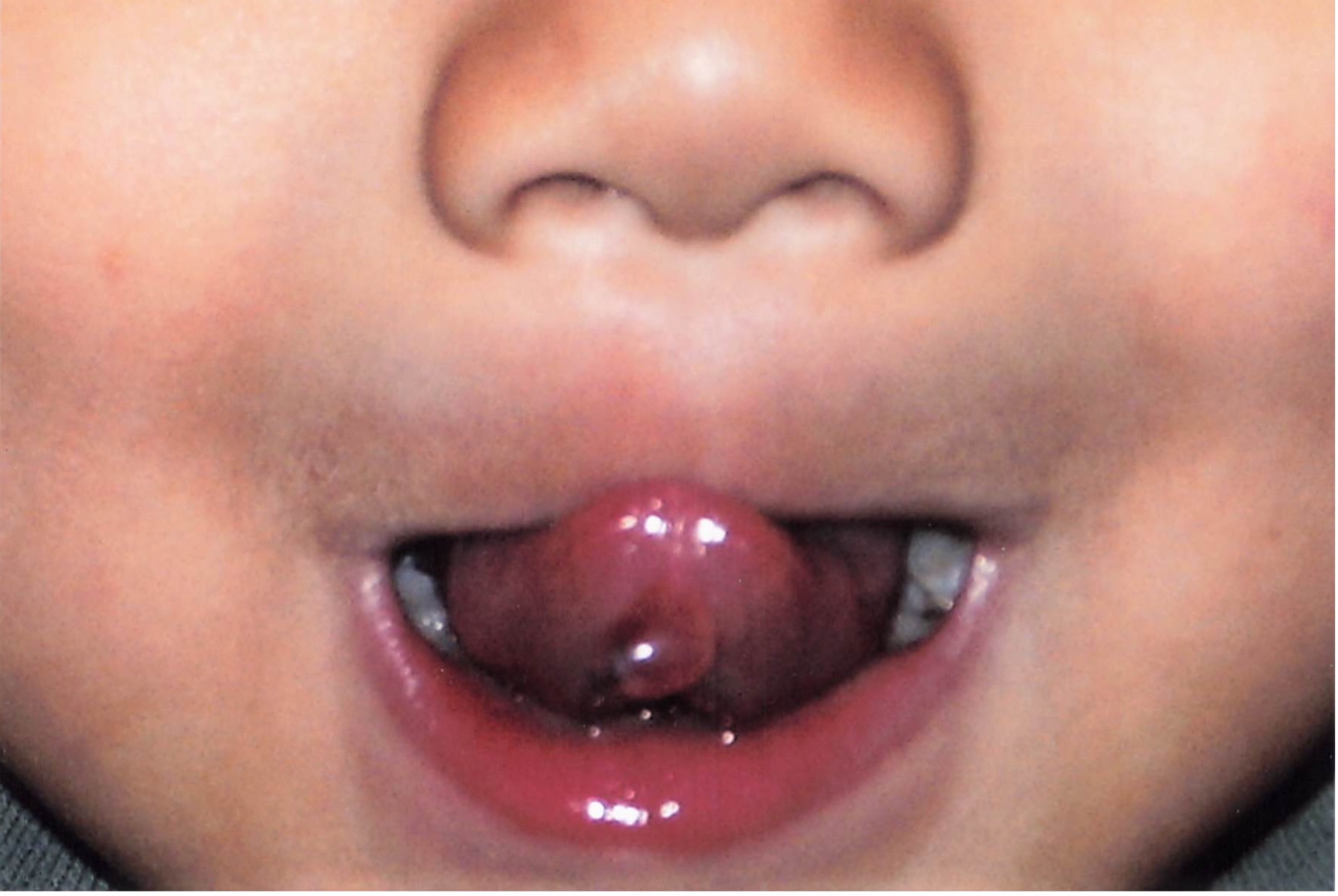 Figure 6. Mucocele