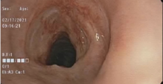 Figure 6. A 6.0-mm endotracheal tube was placed above the stenosis because of the inability to pass the tube through the stenosis with a bronchoscope.
