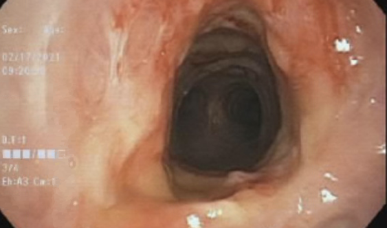 Figure 7. Cannulation for VV ECMO with subsequent bronchoscopy and emergent 4-cm × 15-mm balloon dilation were then performed.