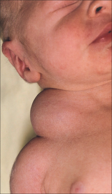 cystic hygroma