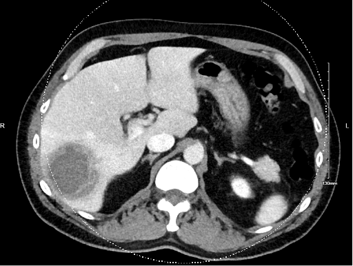 Initial CT scan showing hepatic abscess.