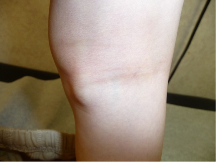 In the pediatric age group, popliteal cysts are the most common lesion behind the knee