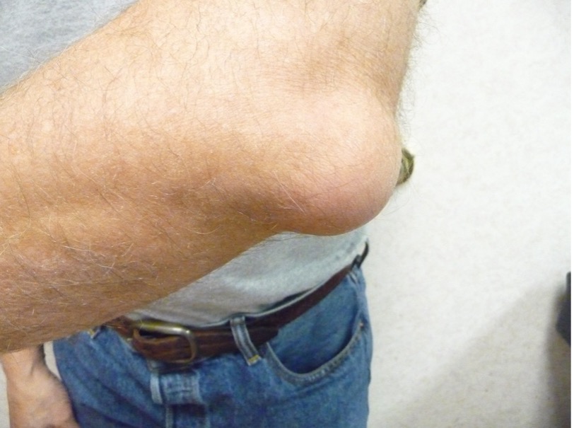 Olecranon bursitis 