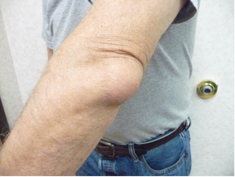 Full elbow range of motion is generally preserved 