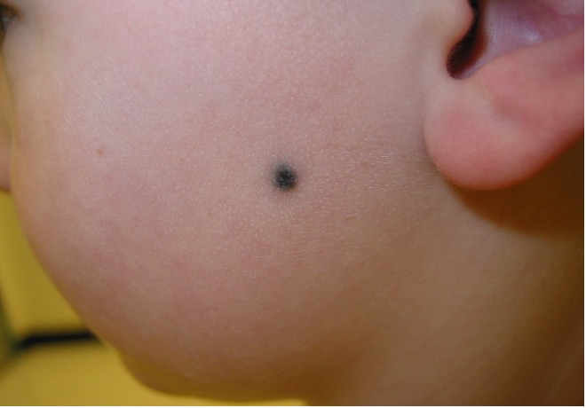 blue nevi on a child's face