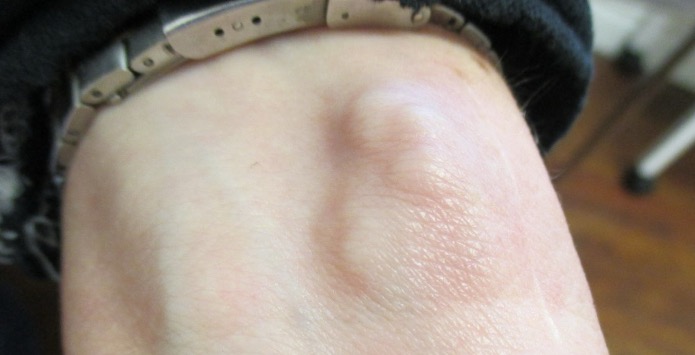 A ganglion cyst presents as a firm, well circumscribed, freely mobile cystic mass adjacent to a tendon or joint.