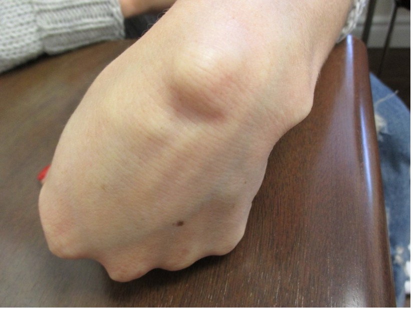 The most common site of ganglion cysts is the dorsum of the wrist 